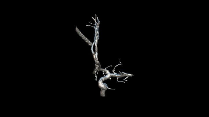 Aneurisma AComA 3D Model