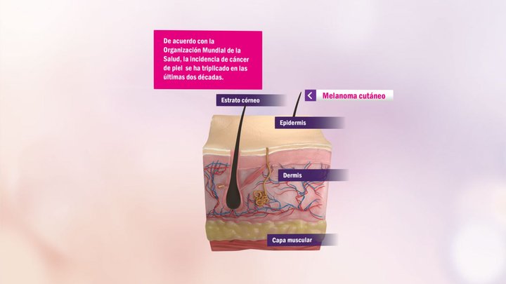 Evolución del cáncer de piel 3D Model
