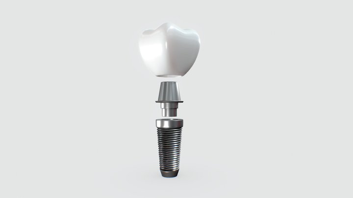 Tooth Implant 3D Model
