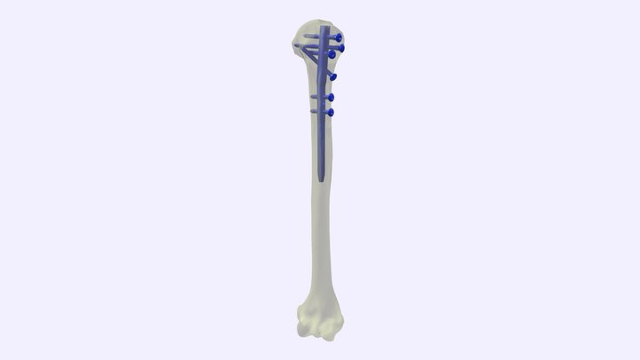 Proximal Humeral Nail "EXPERT"  (150 mm) 3D Model