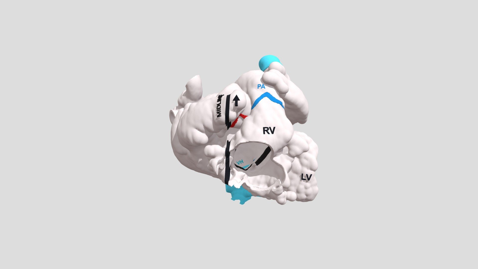 Heterotaxy, Complete AV Canal (H0406) - 3D model by NCH Advanced ...