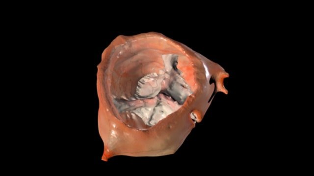 Patient Specific Dilated Aortic Root + Leaflets 3D Model