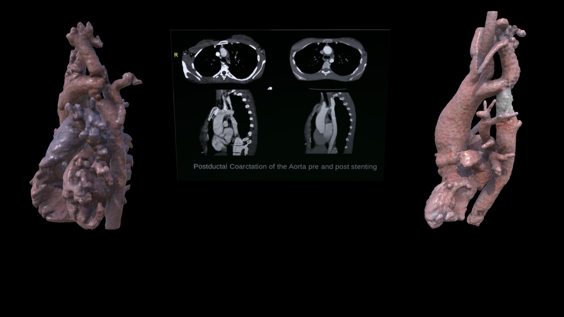 Post Ductal Coarctation of the Aorta
