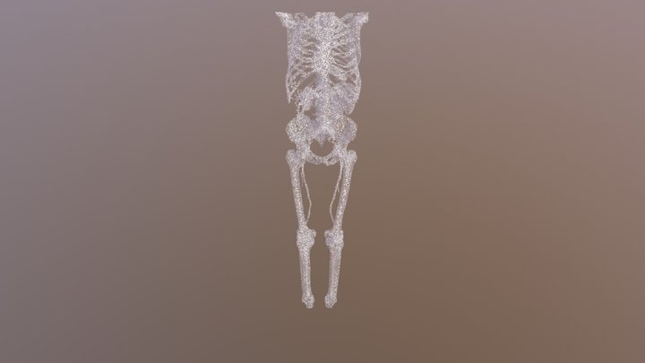Aneurism CTA Nevit Dilmen 0 3D Model