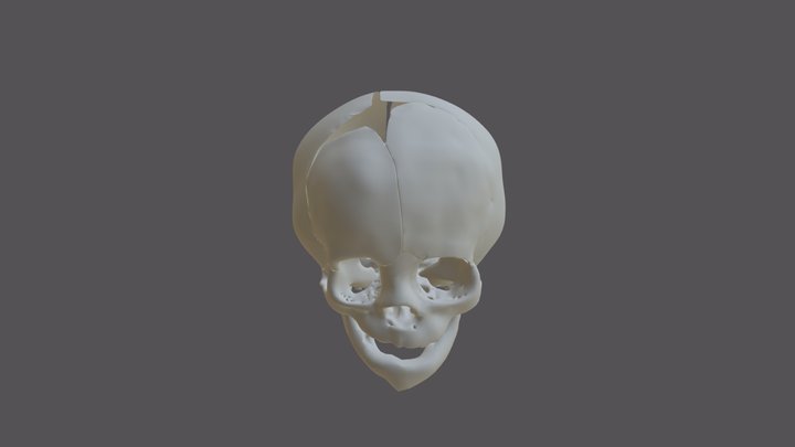 Coronal Synostosis Skull 3D Model