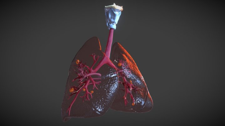 Lung cancer 3D Model