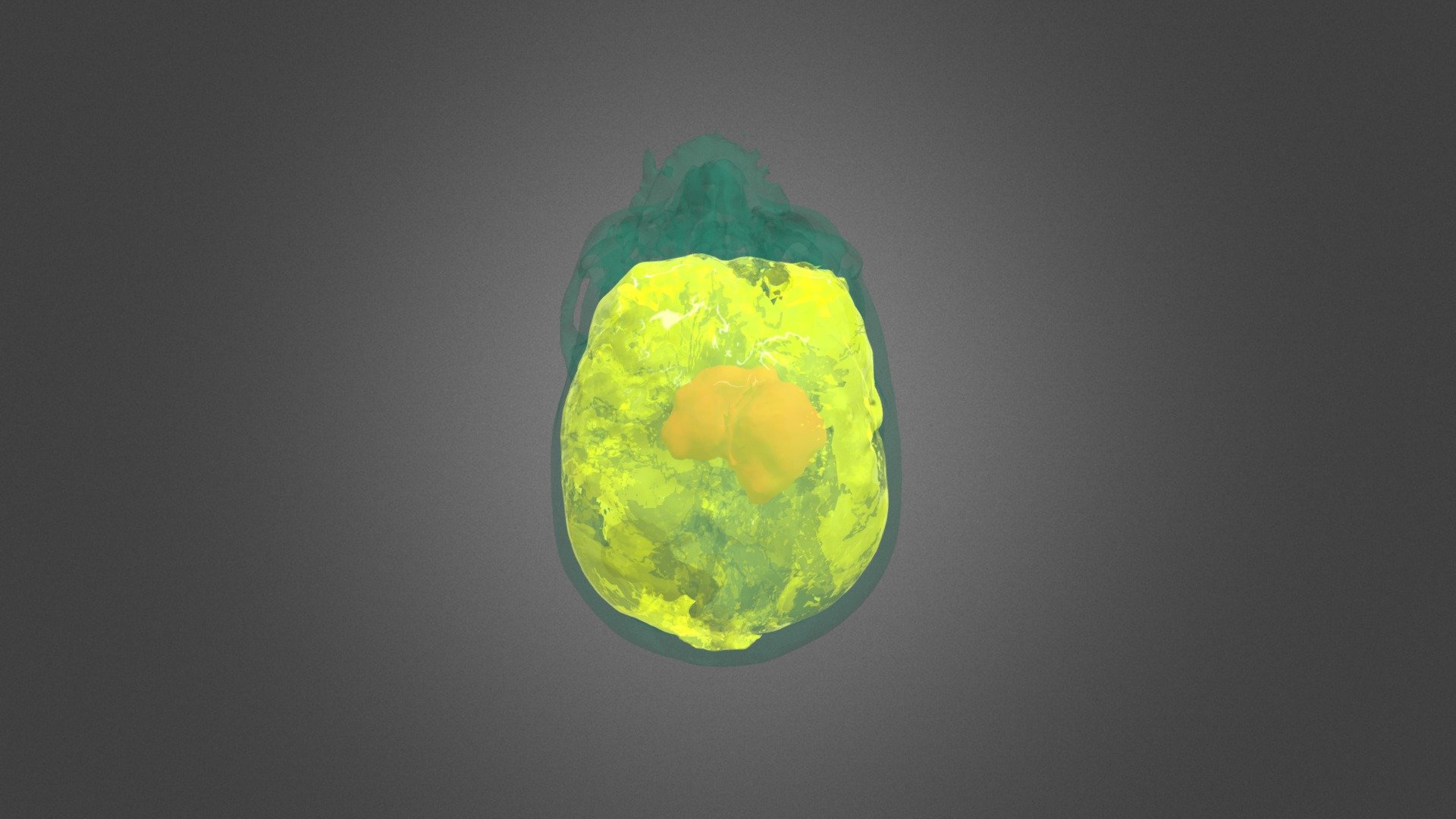 CT Skull and Brain, with Tumor