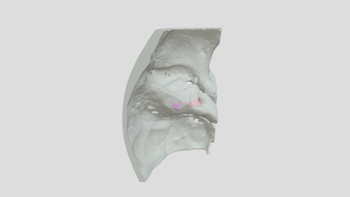 Caso 1 Dr Horcasitas 3D Model