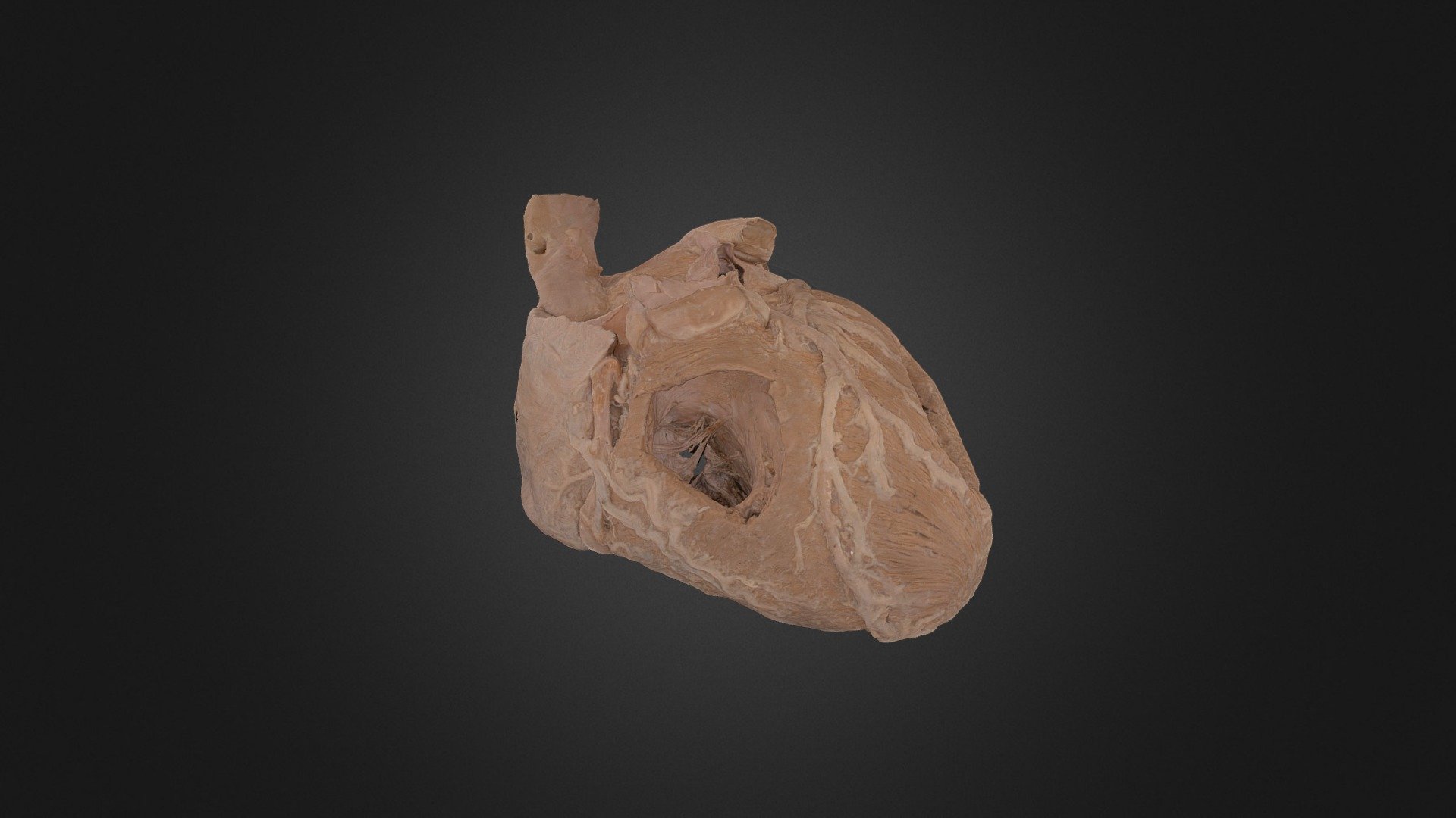 Plastinated Human Heart with Cardiomegaly