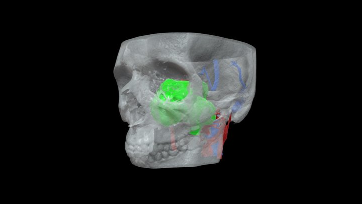 Juvenile Nasopharyngeal Angiofibroma 3D Model