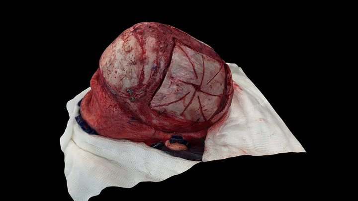 Late Scaphocephaly with frontal bossing (postop) 3D Model