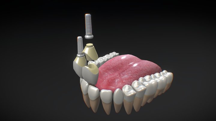 Implantes Dentales 3D Model