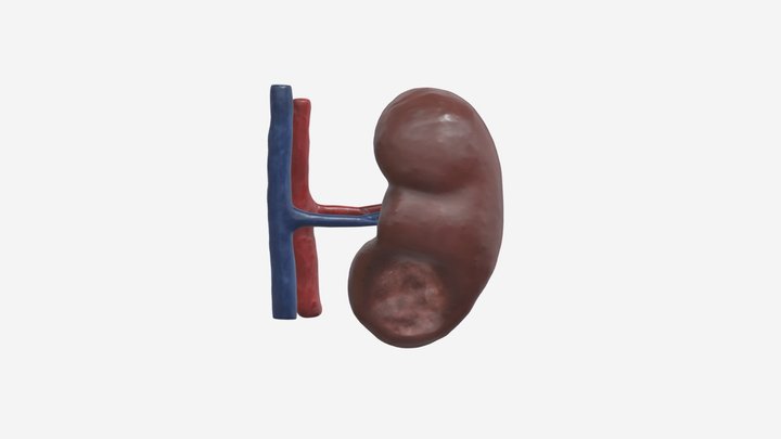 Kidney Cancer - Small Renal Mass (Removed) 3D Model