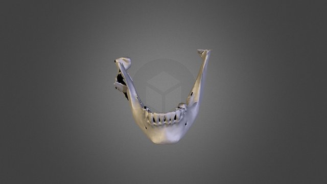 Complex Mandible Fracture 3D Model
