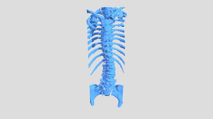 Severe Scoliosis Spine - Post-Op 3D Model
