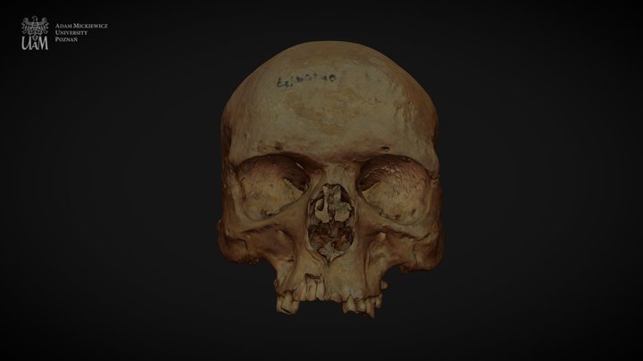 Achondroplastic dwarf - Skull 3D Model