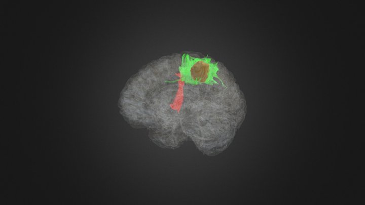Tractography and Tumor with Cortex 3D Model