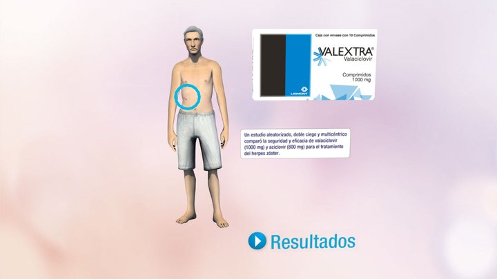 RA2 Herpes 3D Model