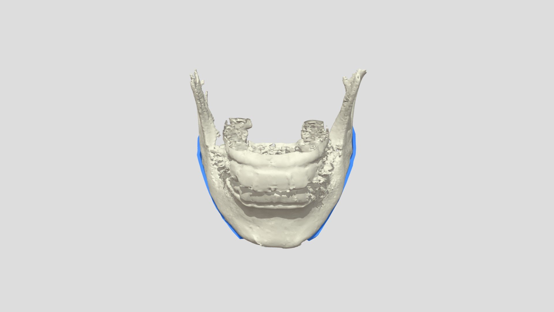 [FACE] CONTOUR SURGERY - IMPLANT