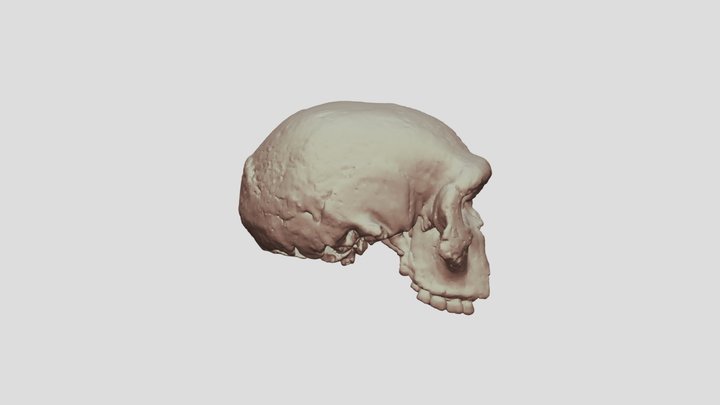 Steinheim Skull CT Scan