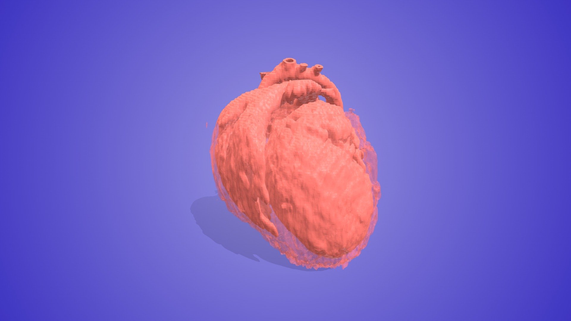 Dilated Cardiomyopathy