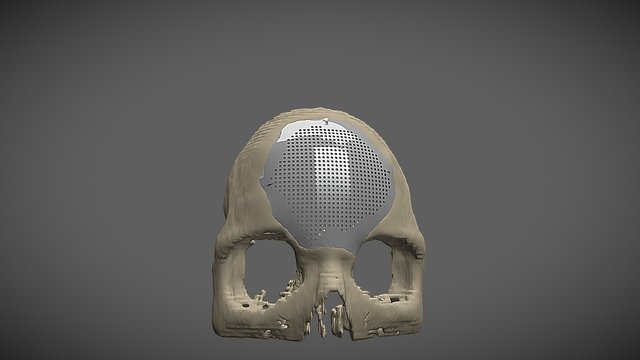 Implant 3D Model