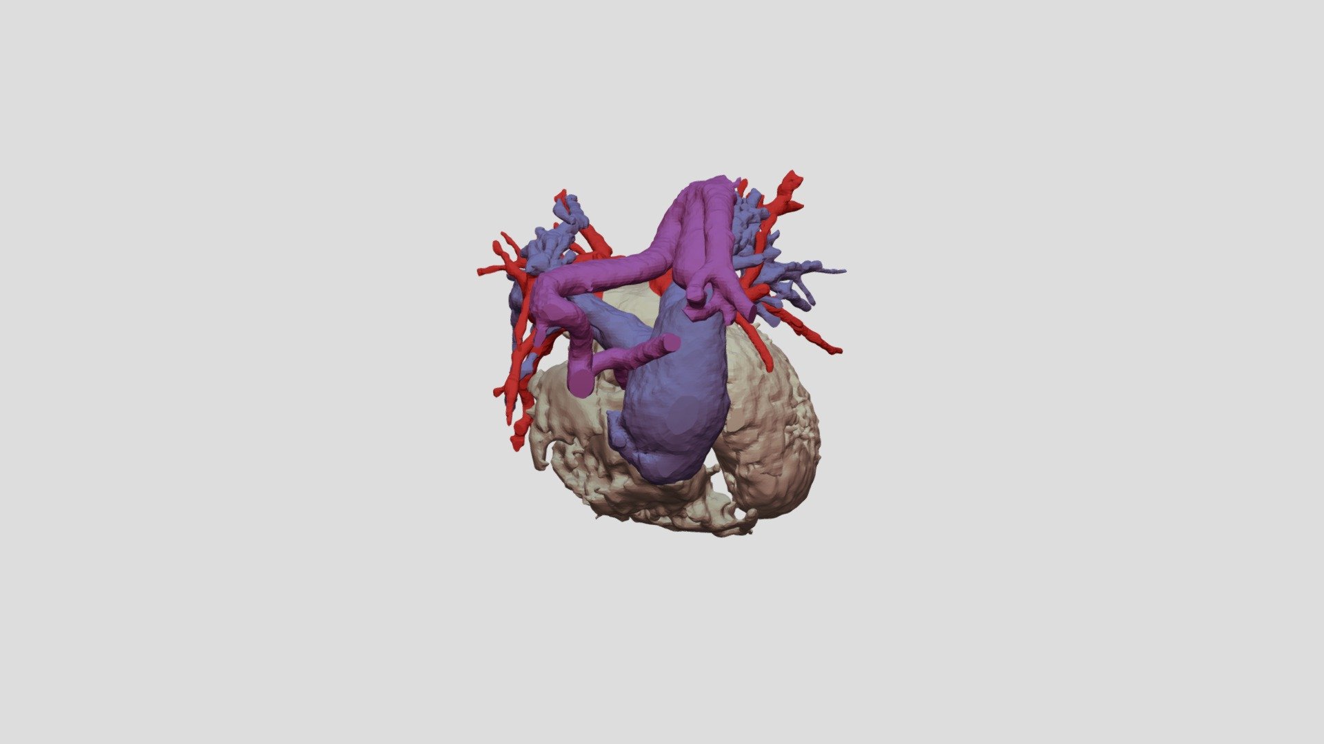 Ext. Aortic atresia, Hypo arch, VSD - 3D model by NCHS Cardiac Advanced ...