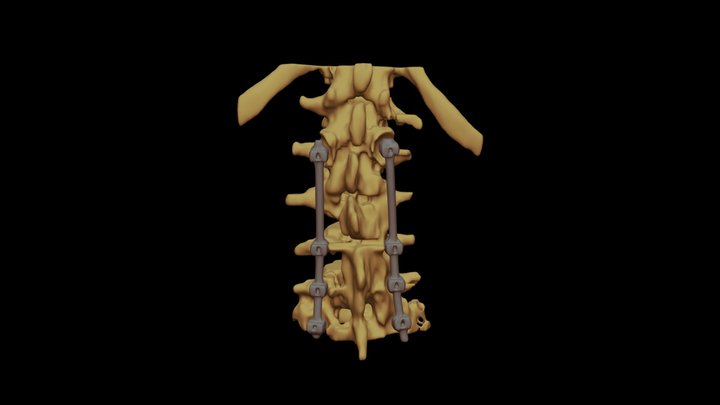 Spine with screws 3D Model