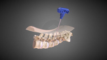 MISQuito ST 2015 3D Model