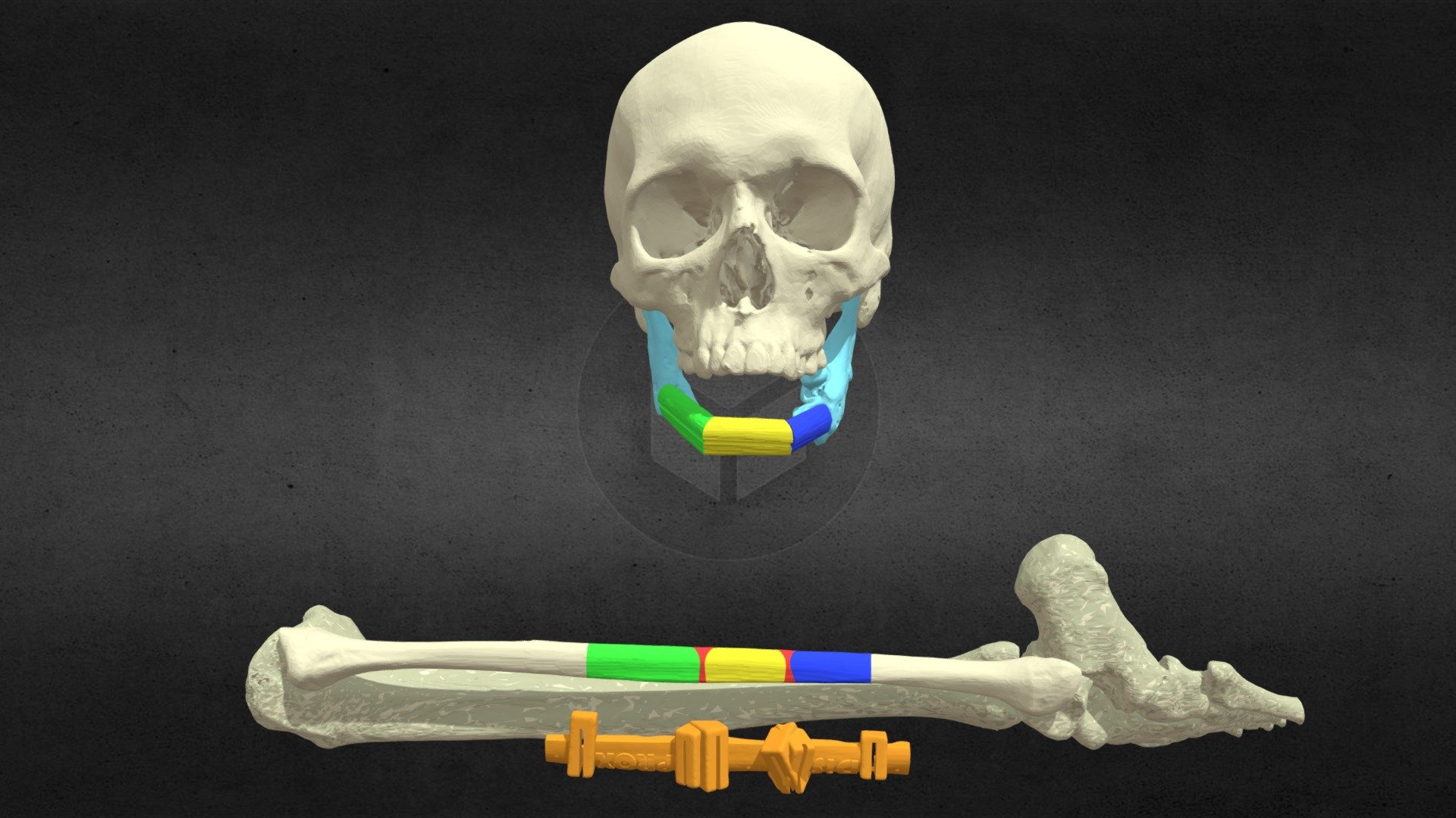 Fibula Free Flap for jaw reconstruction - 3D model by johnnyuday ...