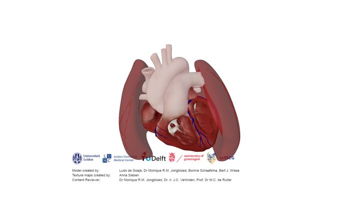 Ventricular Septal Defect – Modello 3D gratuito STL