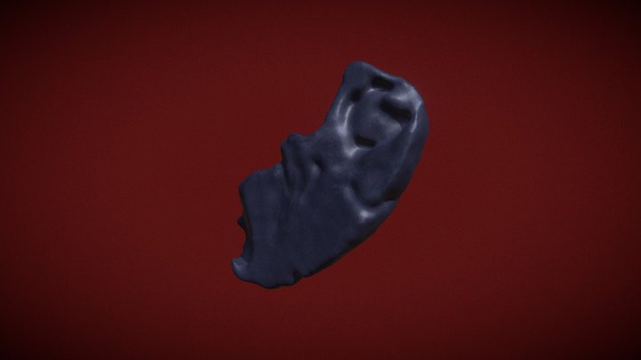 Aspergiloma Pulmonar 3D Model