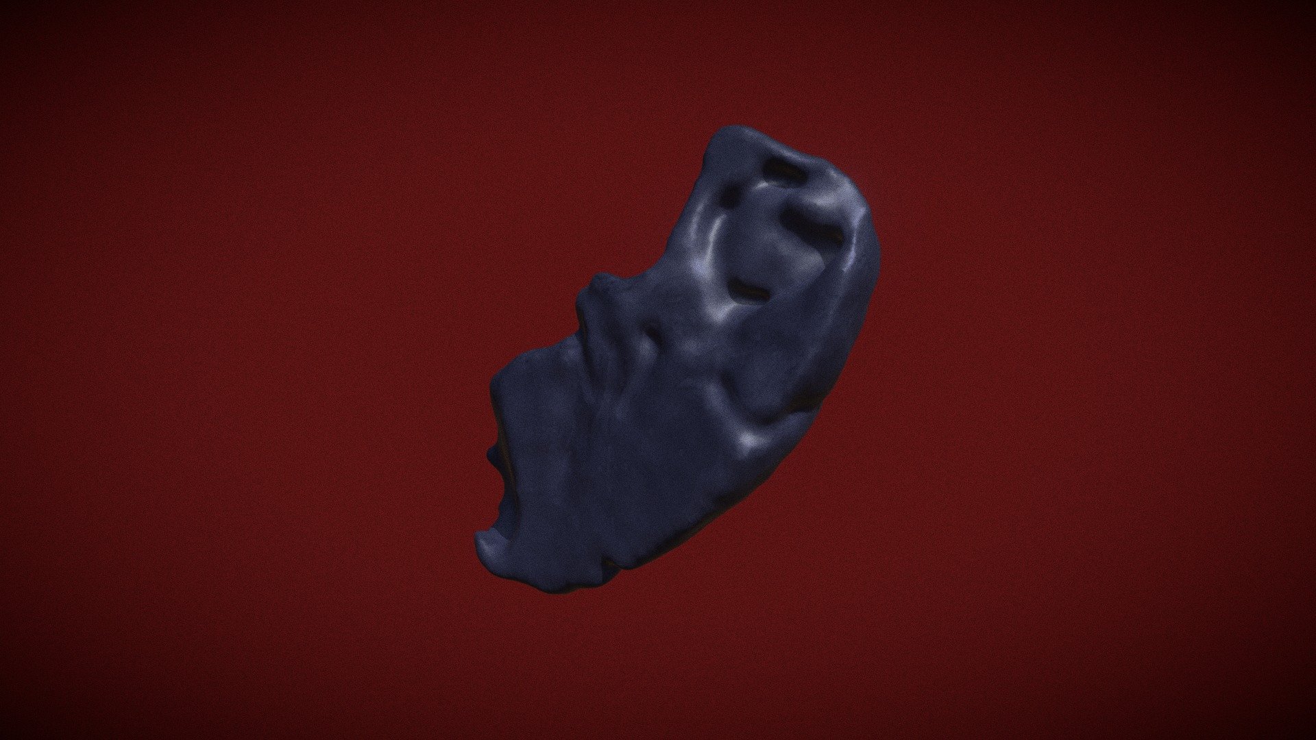 Aspergiloma Pulmonar