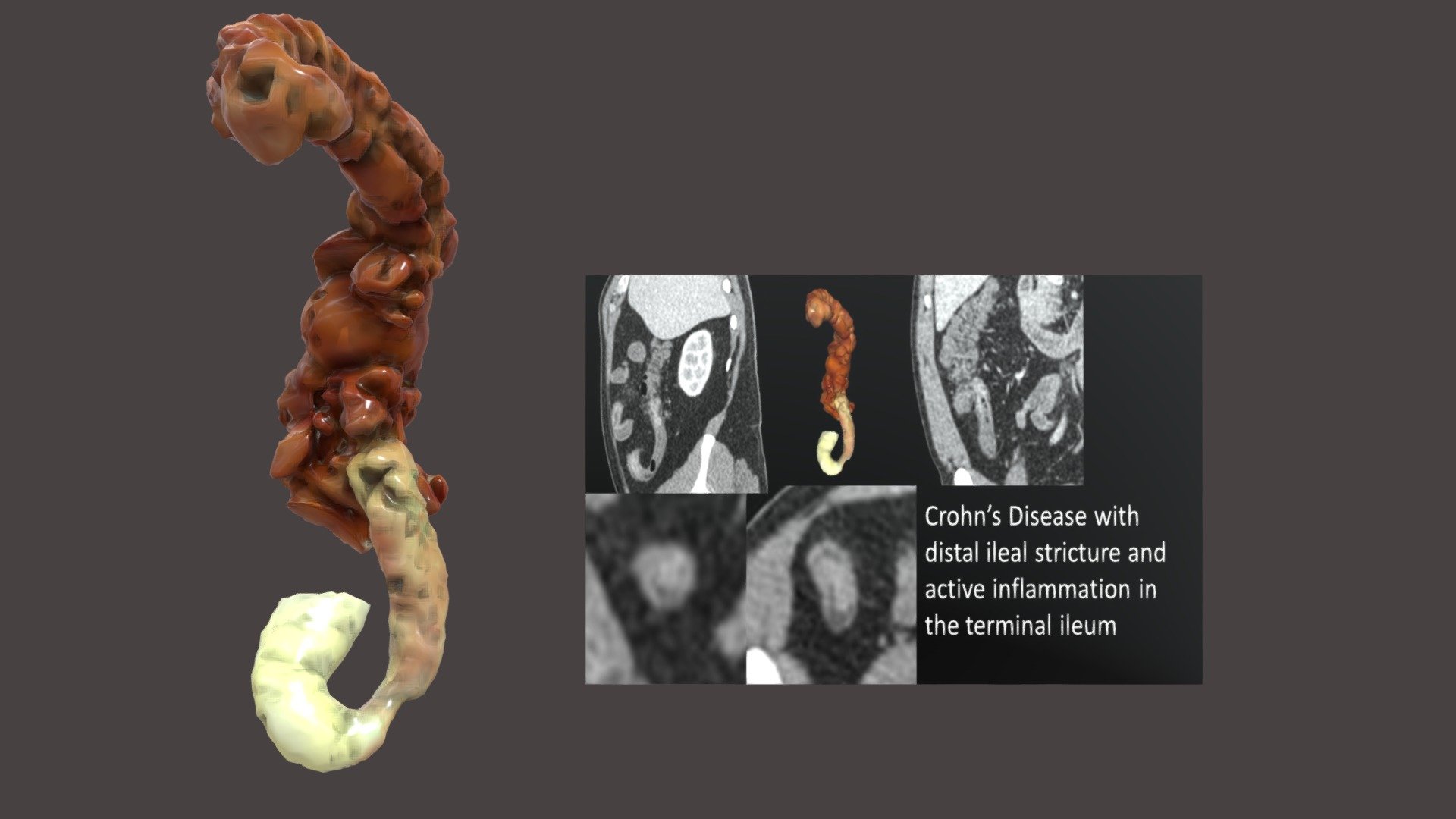 Crohn's Disease Distal Ileum