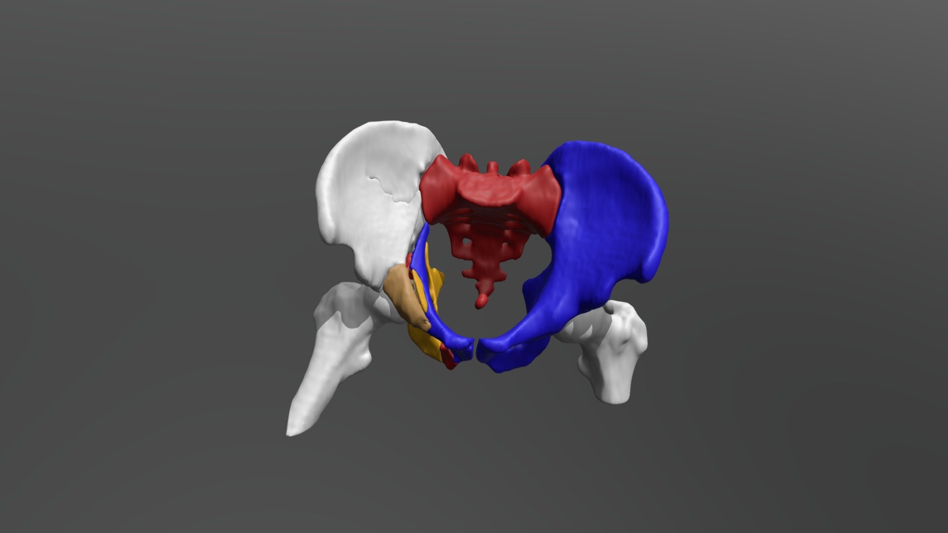 Acetabular Fracture - Both Columns - 3d Model By Valchanov [e5df0cd 