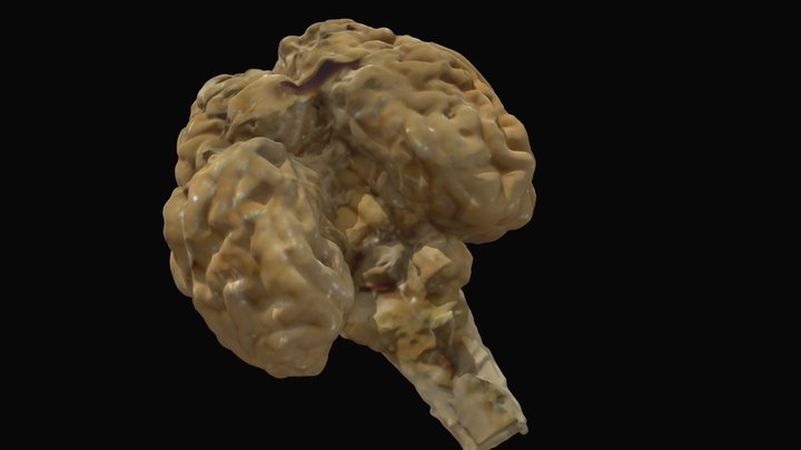 Hypoplasia_brain 3D Model