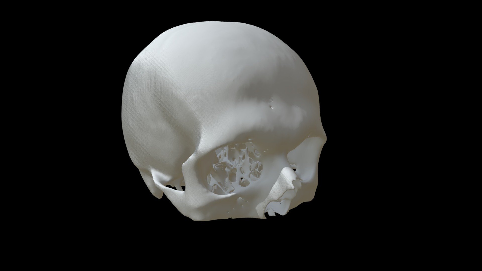 Skull - CT Scan