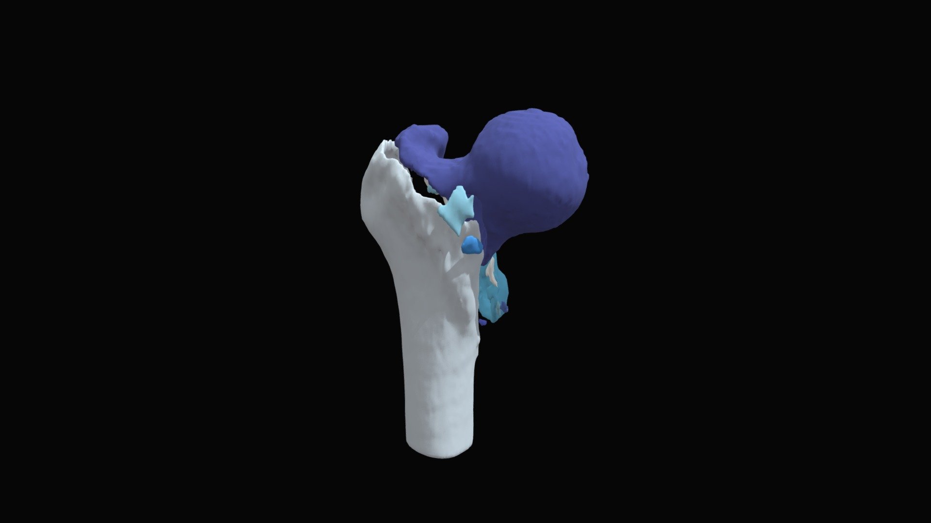 Session 4.04 |  Intertrochanteric Femur | 2 Left
