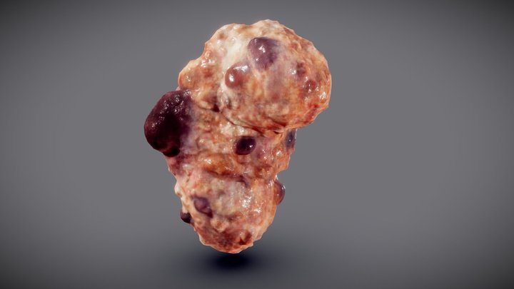 Poly cystic kidney 3D Model