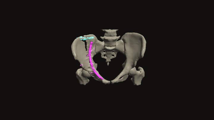 Pelvic Fracture and Implanted Hardware 3D Model