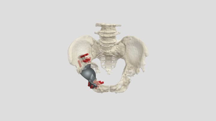 Screw positions patient EM 3D Model