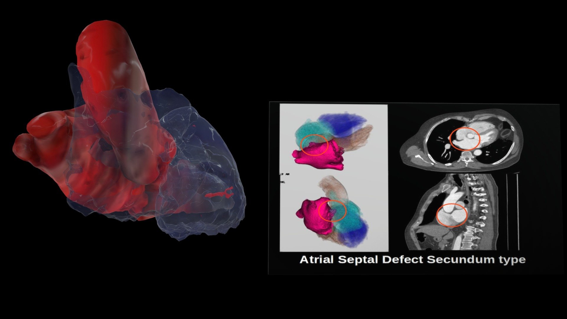 Atrial Septal Defect — Sketchfab embed 3D viewer