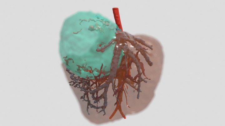 Tumor hepático - CPE_FHO_050724_1 3D Model