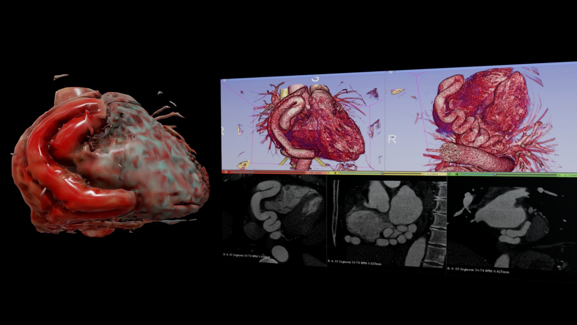 RT Coronary Artery Fistula