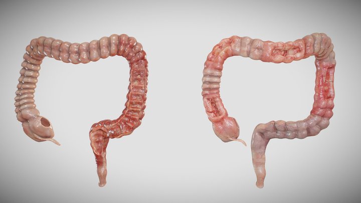 Ulcerative colitis VS Crohn's disease 3D Model