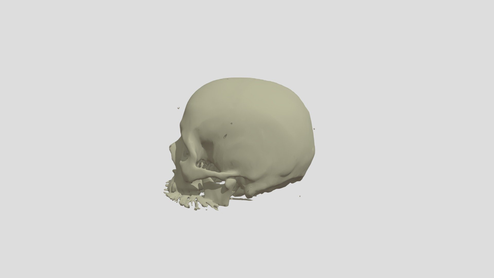 Skull, Brain, And Tumor