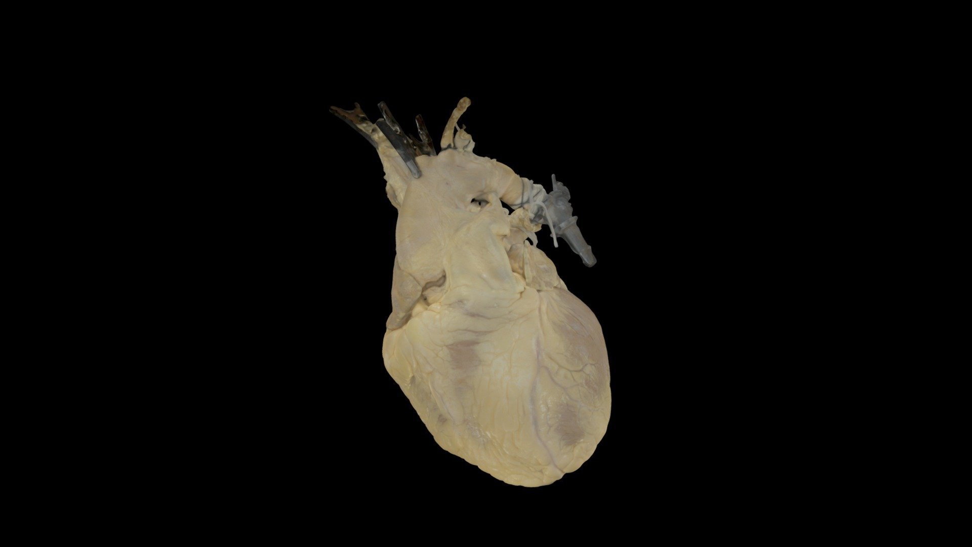 Coronary Artery Disease Fixed Human Heart Download Free 3D model by