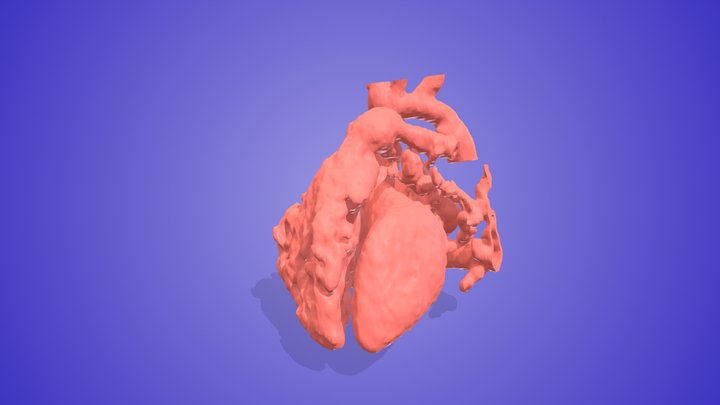 Supracardiac Obstructed TAPVC 3D Model