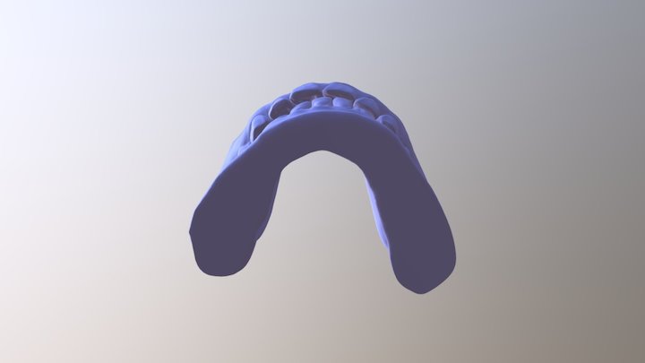 简兰-矫正后-咬合 3D Model