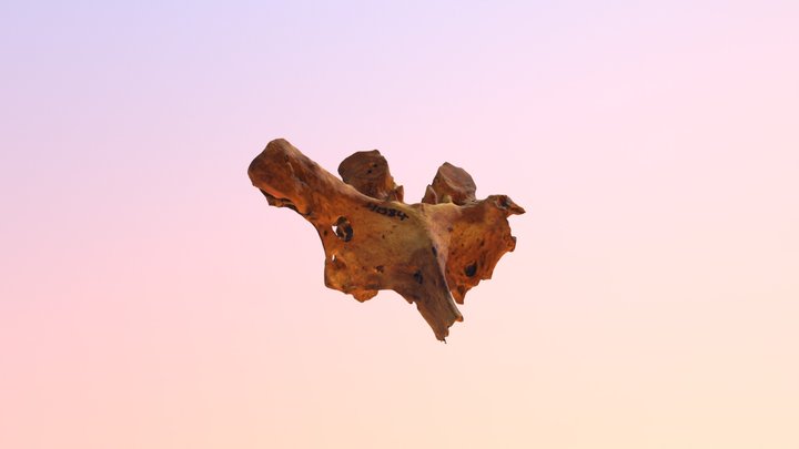 Multiple Myeloma - 8th thoracic vertebra 3D Model